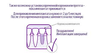 Одномоментная имплантация зубов
