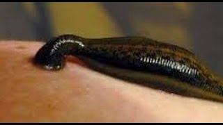 LEECH THERAPY IN VAGINA.  Treatment of Endometriosis, infertility increase sexual driving...