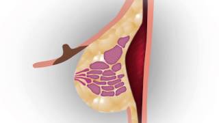 Nipple-Sparing Mastectomy at Memorial Breast Cancer Center