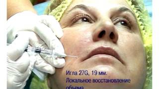 Мастер-класс "Коррекция носогубных складок и периоральной области филлером Regenyal Idea"