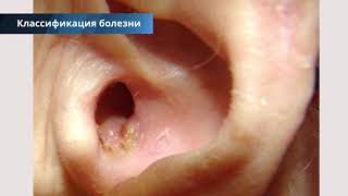 Грибок в ушах - лечение, симптомы, фото с описанием, причины, народные средства