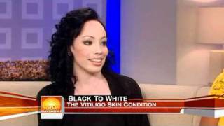 Girl with vitiligo talks about Michael Jackson