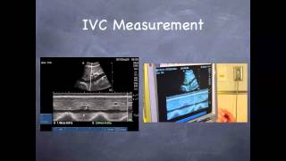 Tutorial: Aorta & IVC