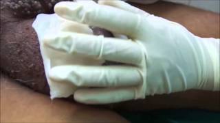 Leech Therapy (Hirudotherapy) in Filariasis, the Genital Destroyer