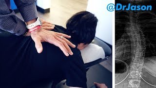 Dr. Jason -CHIROPRACTIC STUDENT WITH SCOLIOSIS GETS ALIGNED