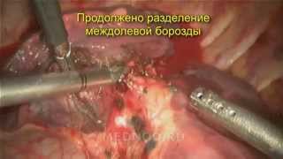 Торакоскопическая верхняя лобэктомия слева (РНЦХ им.акад.Б.В.Петровского)