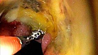 Stomach Cancer on Upper Endoscopy by Dr. Shahab Mehdizadeh