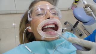 Excellent Hollywood Smile( Veneers) only @Bright White Dental Center