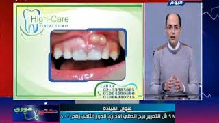 دكتور موري يحذر من عدم علاج الأكياس الدهنية الموجودة بالفم والأسنان والسبب خطير