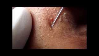 Milia Treatment By Incision