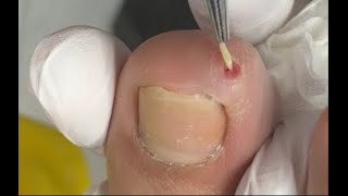 The worst  toenail (Take care of your feet )