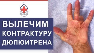 ? Оперативное лечение заболевания Контрактуры Дюпюитрена. Контрактура Дюпюитрена лечение. 12+