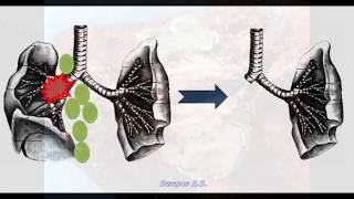 Step by step правосторонняя пневмонэктомия при раке (РНЦХ)
