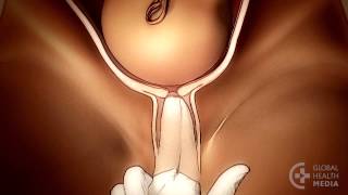 The Vaginal Exam in Labor (Spanish) - Childbirth Series