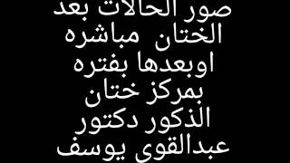 #طهاره و#ختان الذكور صور بعد #الختان  .دكتور عبدالقوي يوسف