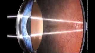 "Retinosis Pigmentaria" Una Visión limitada