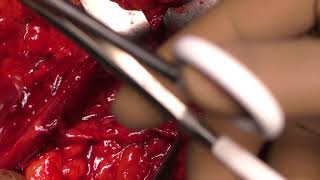 Penile revascularisation for Erectile Dysfunction after PFUDD
