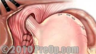 Hernia Hiatal Laparoscopic PreOp® Patient Education Feature