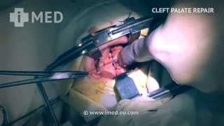 Cleft Palate Repair (palatoplasty) - Палатопластика (волчья пасть) - Պալատոպլաստիկա (գայլի երախ)