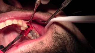 Extraction #13 with Simple Socket Bone Grafting