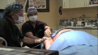 Vaser Lipo ARMS