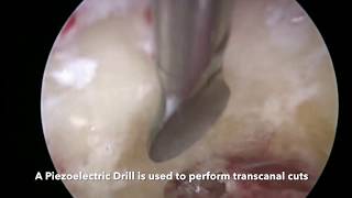 Endoscopic Cholesteatoma Surgery with Piezoelectric Drill