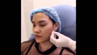 Botox หน้าเรียว ลดโหนก อทิตา คลินิก atita clinic