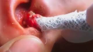 Выдавливание огромного прыща Squeezing big pimple в ухе