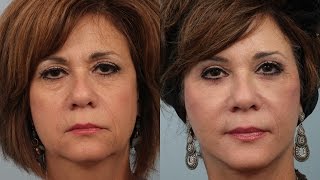 Female Weekend Facelift/Neck Lift Before and After by Dr. Edwin Williams