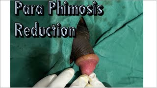 PARAPHIMOSIS REDUCTION