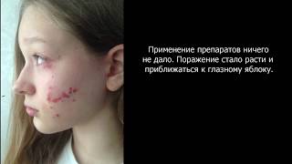 Бальзам и Клещевое поражение на лице. Методика лечения.