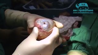Cambio de implantes de senos