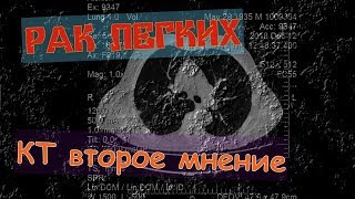 МЕТАСТАЗЫ В ЛЕГКИХ на рентгене  КТ легких   что показывает расшифровка диска