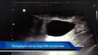 Лечение кист молочных желез (склеротерапия)