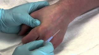 Intravenous Catheter Placement