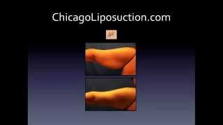 How to Choose a Cosmetic Plastic Surgeon for Liposuction: Chicago Liposuction Doctor's Advice