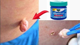 Best and Effective Way To Remove Skin Tags Naturally || Home Remedies To Remove Skin Tags