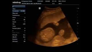 Ecografía semana 21 de embarazo - Niño!