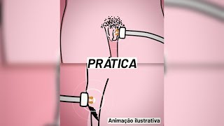 Radiofrequência para Estética Íntima na PRÁTICA!