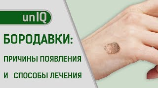 БОРОДАВКИ: причины ПОЯВЛЕНИЯ и как их ЛЕЧИТЬ?