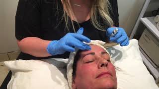 FACIAL CON  MICROAGUJAS /TRATAMIENTO MICRONEEDLING /DERMAPEN