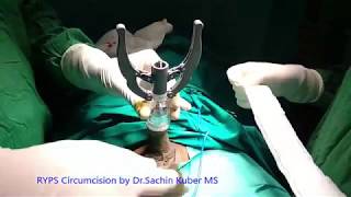 RYPS Stitchless Painless Circumcision Surgery by Dr.Kuber Call +919370275336/+919370240098