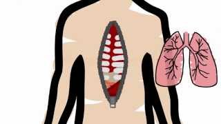 Lung Transplants