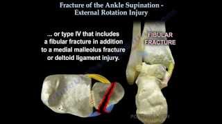 Ankle fracture , Supination External Rotation - Everything You Need To Know - Dr. Nabil Ebraheim