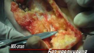 Dupuytren's Contracture - radical fasciectomy DUPUYTREN.RU