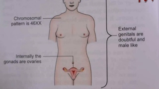 Health Focus: Dealing with ambiguous genitalia in intersex children
