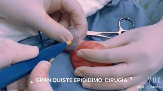 GRAN QUISTE DE EPIDIDIMO. CIRUGÍA