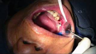 Mở vạt bằng mũi Trefine làm cầu 2 Implant 4.5-4.7 mang 3 thân răng sứ