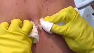 Выдавливание огромного прыща Squeezing big pimple