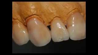 Diagnostic Wax-Up for Treatment Planning